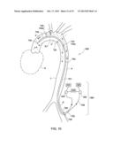 ARTERIAL DEVICE, SYSTEM AND METHOD FOR REMOVING EMBOLIC DEBRIS diagram and image