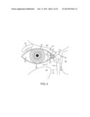 IMPLANT DEVICE, TOOL, AND METHODS RELATING TO TREATMENT OF PARANASAL     SINUSES diagram and image