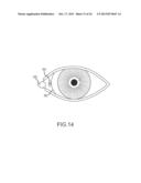 IMPLANT DEVICE, TOOL, AND METHODS RELATING TO TREATMENT OF PARANASAL     SINUSES diagram and image