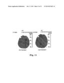 SYSTEM AND METHOD FOR IMPROVING OUTCOME OF CEREBRAL ISCHEMIA diagram and image