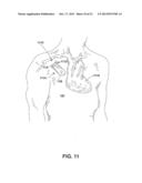 FEEDBACK-BASED DIURETIC OR NATRIURETIC MOLECULE ADMINISTRATION diagram and image