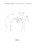 FEEDBACK-BASED DIURETIC OR NATRIURETIC MOLECULE ADMINISTRATION diagram and image