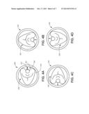 ABLATION CATHETER AND METHODS FOR NERVE MODULATION diagram and image