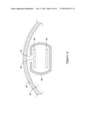 RENAL NERVE MODULATION CATHETER DESIGN diagram and image