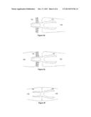 OSTEOSYNTHESIS DEVICE diagram and image