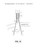 SURGICAL TISSUE COLLECTION BAG diagram and image