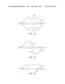 APPARATUS FOR OCCLUDING BODY LUMENS diagram and image