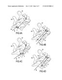 ORTHOPAEDIC DEVICE AND METHODS FOR ITS PRE-ASSEMBLY AND ASSEMBLY diagram and image