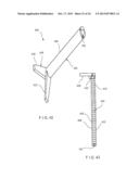 MINIMALLY INVASIVE IMPLANT AND CRIMPING SYSTEM diagram and image