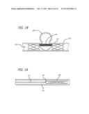 METHODS AND DEVICES FOR TREATMENT OF VASCULAR DEFECTS diagram and image