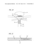 METHODS AND DEVICES FOR TREATMENT OF VASCULAR DEFECTS diagram and image