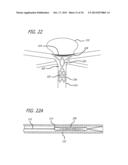 METHODS AND DEVICES FOR TREATMENT OF VASCULAR DEFECTS diagram and image