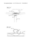 METHODS AND DEVICES FOR TREATMENT OF VASCULAR DEFECTS diagram and image