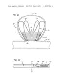 METHODS AND DEVICES FOR TREATMENT OF VASCULAR DEFECTS diagram and image