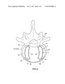 VERTEBRAL BODY SPACER diagram and image