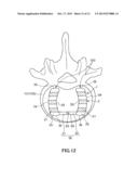 VERTEBRAL BODY SPACER diagram and image