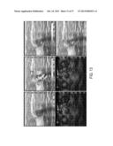 NOISE SUPPRESSION IN AN OPTOACOUSTIC SYSTEM diagram and image