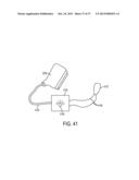 NOISE SUPPRESSION IN AN OPTOACOUSTIC SYSTEM diagram and image