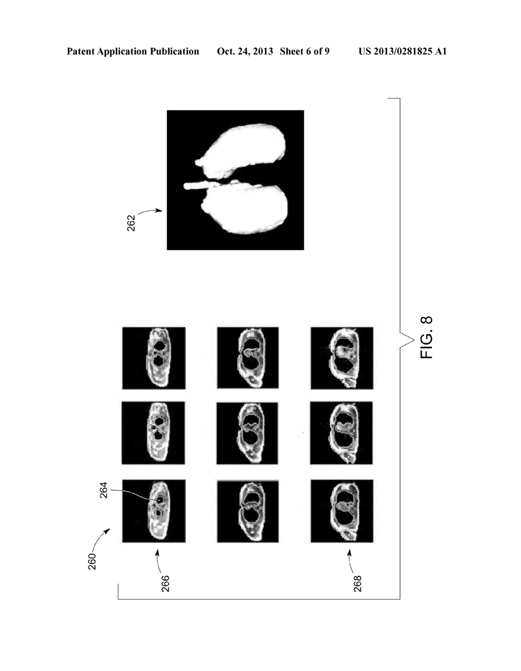 ATTENUATION CORRECTION IN POSITRON EMISSION TOMOGRAPHY USING MAGNETIC     RESONANCE IMAGING - diagram, schematic, and image 07