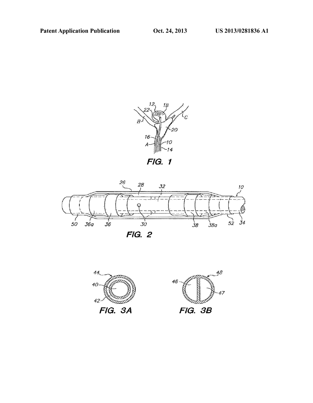 OCCLUSION CATHETER HAVING COMPLIANT BALLOON FOR USE WITH COMPLEX     VASCULATURE - diagram, schematic, and image 02