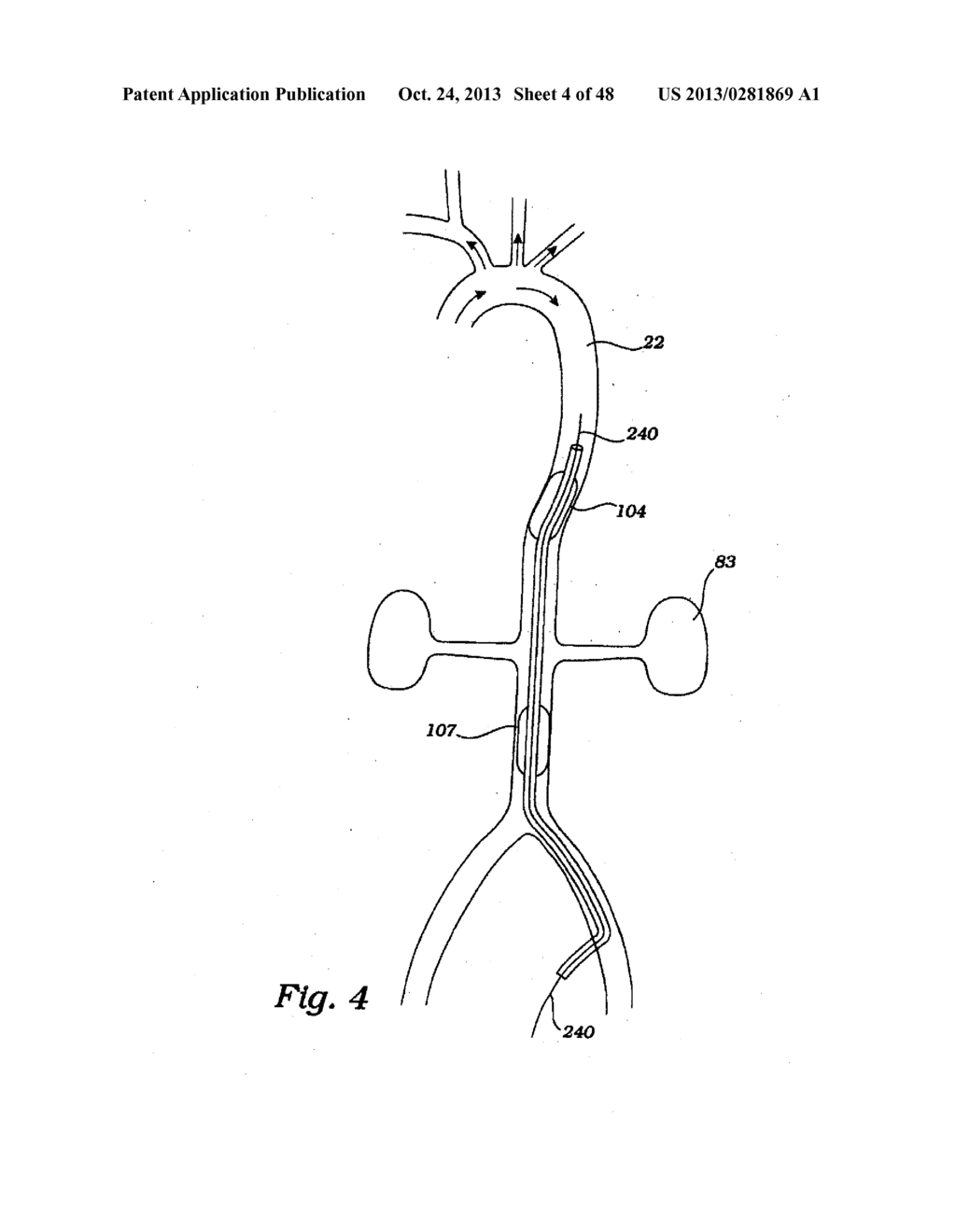 PARTIAL AORTIC OCCLUSION DEVICES AND METHODS FOR CEREBRAL PERFUSION     AUGMENTATION - diagram, schematic, and image 05