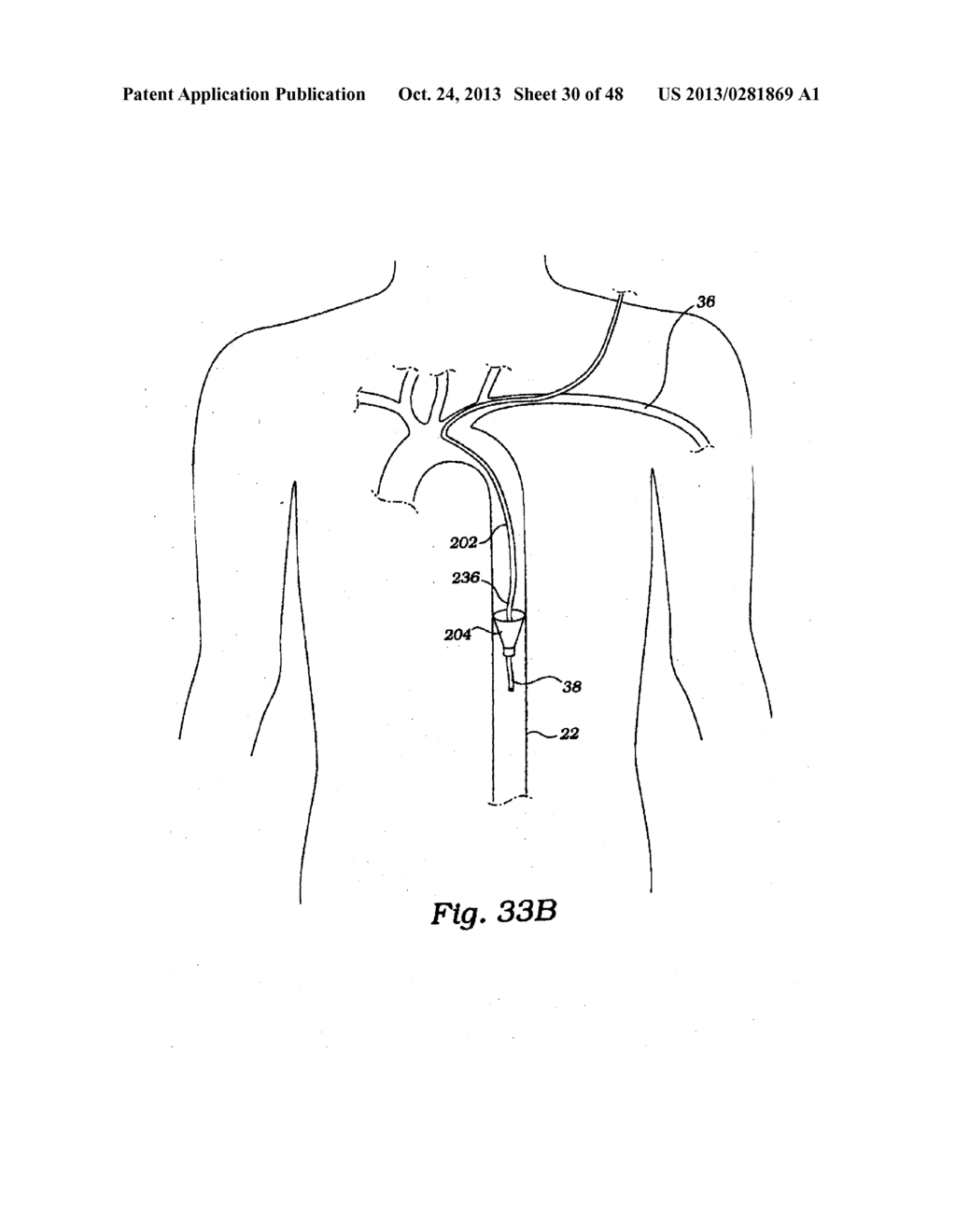 PARTIAL AORTIC OCCLUSION DEVICES AND METHODS FOR CEREBRAL PERFUSION     AUGMENTATION - diagram, schematic, and image 31