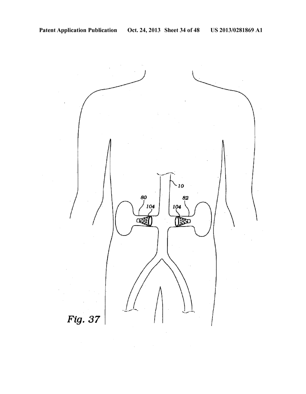 PARTIAL AORTIC OCCLUSION DEVICES AND METHODS FOR CEREBRAL PERFUSION     AUGMENTATION - diagram, schematic, and image 35
