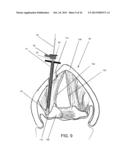 DEVICES AND METHODS FOR ANTERIOR ARYTENOID ADDUCTION diagram and image