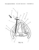 DEVICES AND METHODS FOR ANTERIOR ARYTENOID ADDUCTION diagram and image