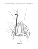 DEVICES AND METHODS FOR ANTERIOR ARYTENOID ADDUCTION diagram and image