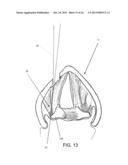 DEVICES AND METHODS FOR ANTERIOR ARYTENOID ADDUCTION diagram and image