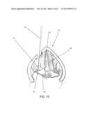 DEVICES AND METHODS FOR ANTERIOR ARYTENOID ADDUCTION diagram and image