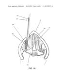 DEVICES AND METHODS FOR ANTERIOR ARYTENOID ADDUCTION diagram and image