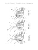 DEVICES AND METHODS FOR ANTERIOR ARYTENOID ADDUCTION diagram and image