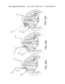 DEVICES AND METHODS FOR ANTERIOR ARYTENOID ADDUCTION diagram and image