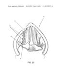 DEVICES AND METHODS FOR ANTERIOR ARYTENOID ADDUCTION diagram and image