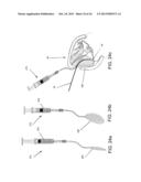 DEVICES AND METHODS FOR ANTERIOR ARYTENOID ADDUCTION diagram and image