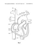 RETROGRADE CARDIOPLEGIA DELIVERY CATHETER AND METHOD FOR INDUCING     CARDIOPLEGIC ARREST diagram and image