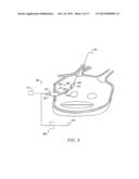 CIRCUMFERENTIAL ABLATION DEVICE ASSEMBLY diagram and image