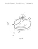 CIRCUMFERENTIAL ABLATION DEVICE ASSEMBLY diagram and image