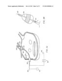 CIRCUMFERENTIAL ABLATION DEVICE ASSEMBLY diagram and image