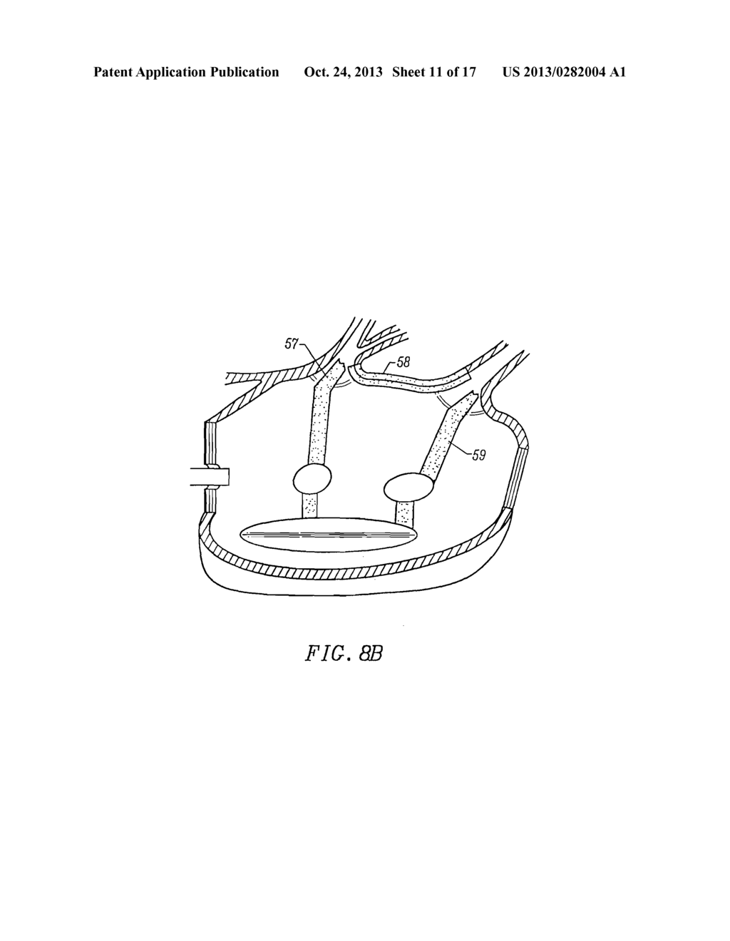 CIRCUMFERENTIAL ABLATION DEVICE ASSEMBLY - diagram, schematic, and image 12