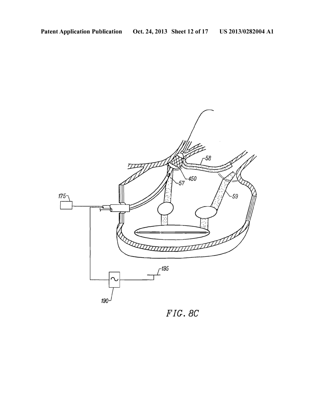 CIRCUMFERENTIAL ABLATION DEVICE ASSEMBLY - diagram, schematic, and image 13