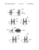 OCCLUSION DEVICE FOR UNDESIRED OPENINGS IN THE HEART diagram and image