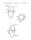 HEART VALVE ASSEMBLY SYSTEMS AND METHODS diagram and image