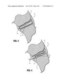 SPINAL FACET AUGMENTATION IMPLANT AND METHOD diagram and image