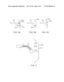 METHOD OF INSERTING AN IMPLANT INTO A CAVITY IN A PERIOSTEUM REGION diagram and image