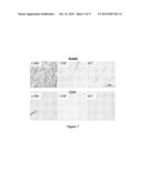 TREATMENT FOR DUPUYTREN S DISEASE diagram and image