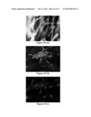 TREATMENT FOR DUPUYTREN S DISEASE diagram and image