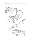 STOMACH-SPANNING GASTRIC IMPLANTS diagram and image